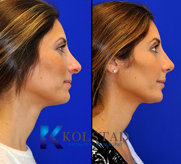 Before and after revision rhinoplasty in San Diego showing improved nasal alignment, smoother bridge contour, and refined tip structure