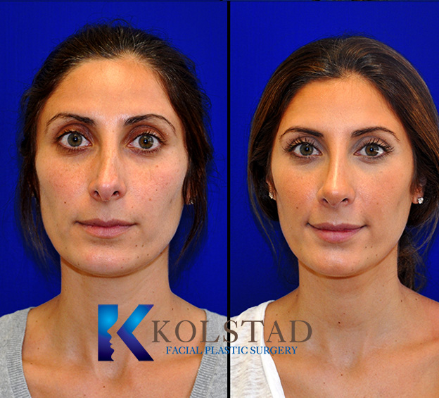 Before and after revision rhinoplasty in California showing improved nasal symmetry, refined bridge contour, and corrected tip shape