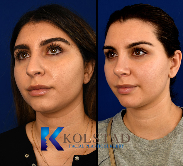 Before and after Middle Eastern rhinoplasty in California showing refined nasal bridge and improved profile while maintaining natural ethnic features