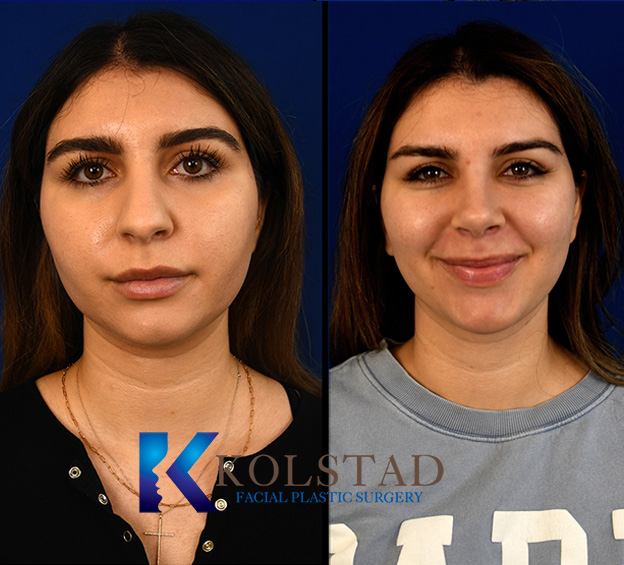 Before and after Middle Eastern rhinoplasty in San Diego showing improved nasal bridge smoothness and refined tip while preserving ethnic balance
