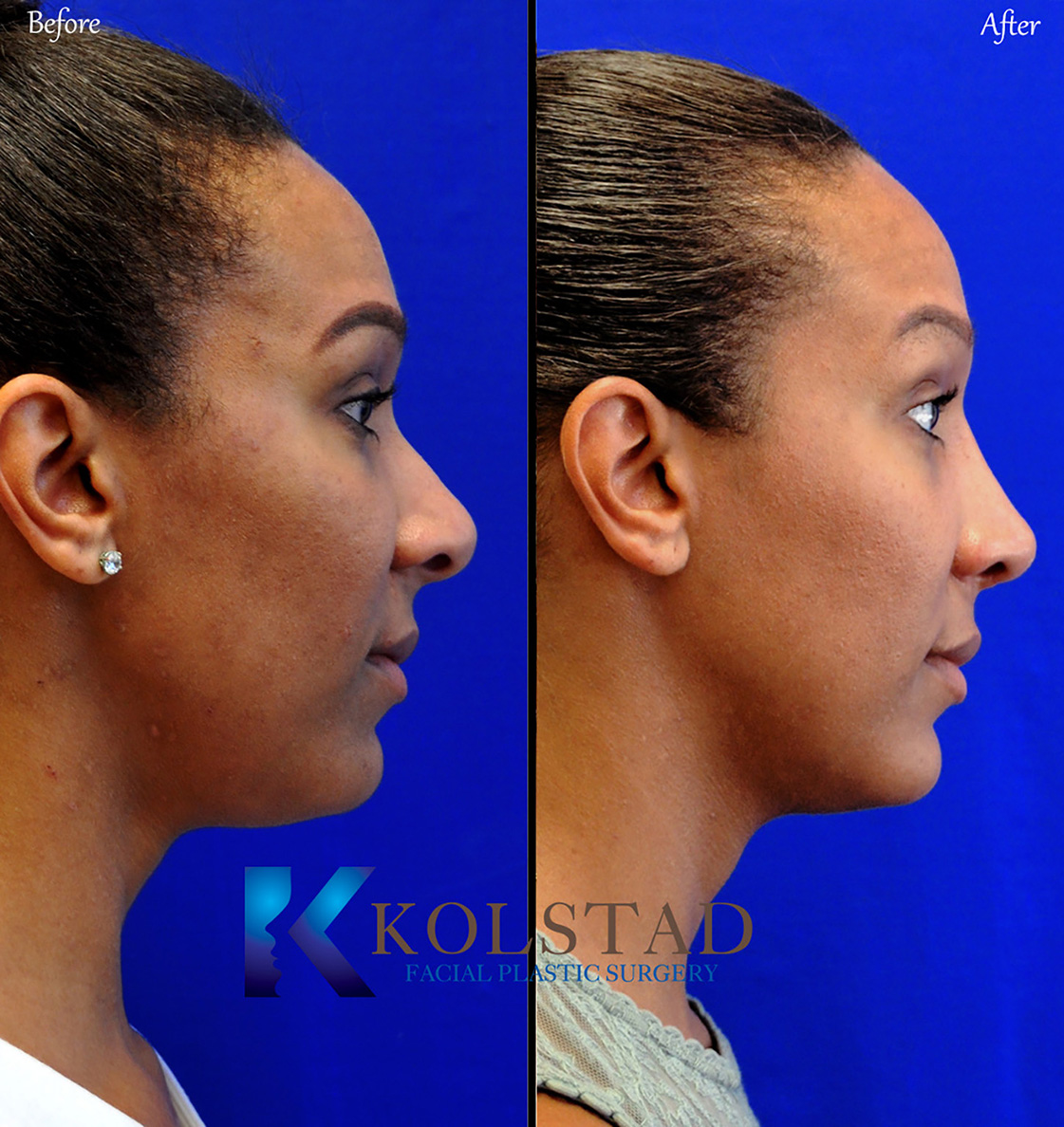 African American rhinoplasty before and after showing refined nasal contours from front and profile views in San Diego, California