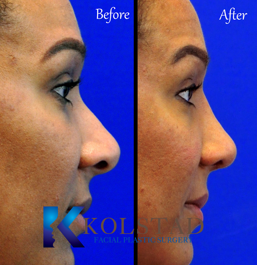 African American rhinoplasty before and after showing a naturally refined nose and balanced facial proportions in San Diego, California