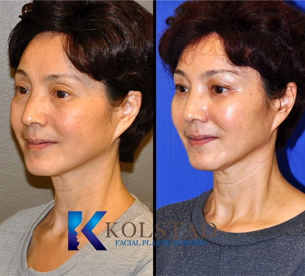 Before and after Asian periorbital fat transfer showing improved under eye hollows and smoother transition between lower eyelid and cheek