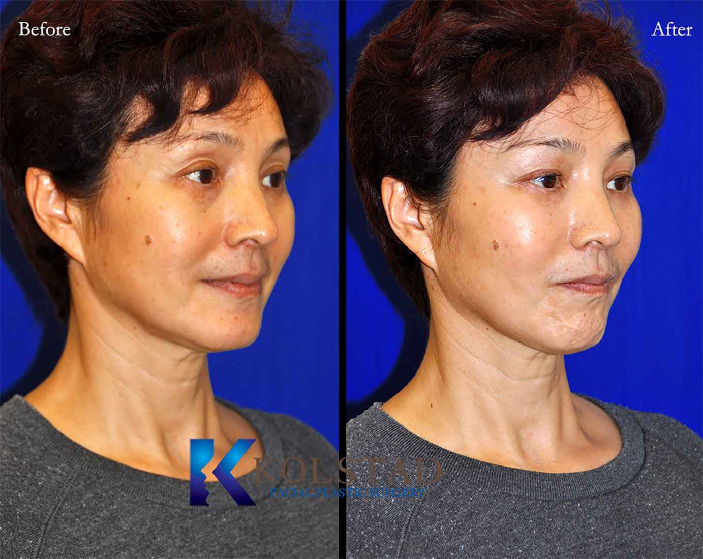 Before and after Asian eyelid surgery in California showing natural eyelid crease creation and improved eyelid definition