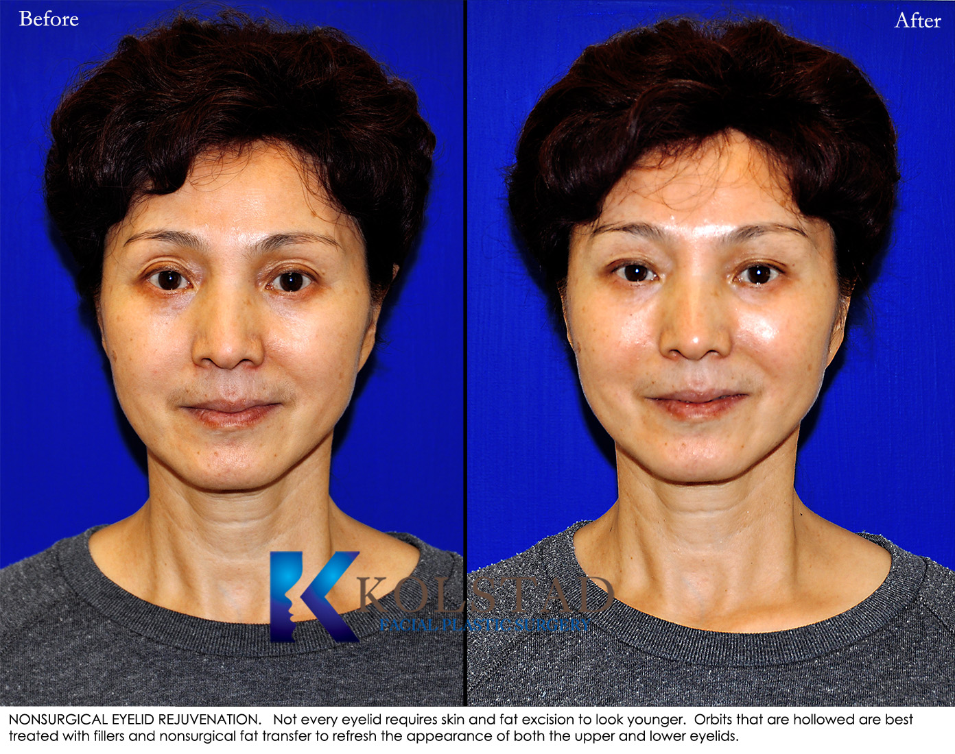 Before and after Asian blepharoplasty in San Diego showing improved eyelid crease definition and a more open, natural eye appearance