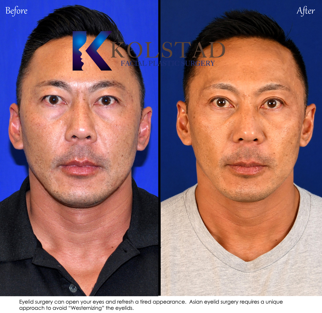 Before and after Asian eyelid surgery showing smoother eyelid contour and reduced under eye bags