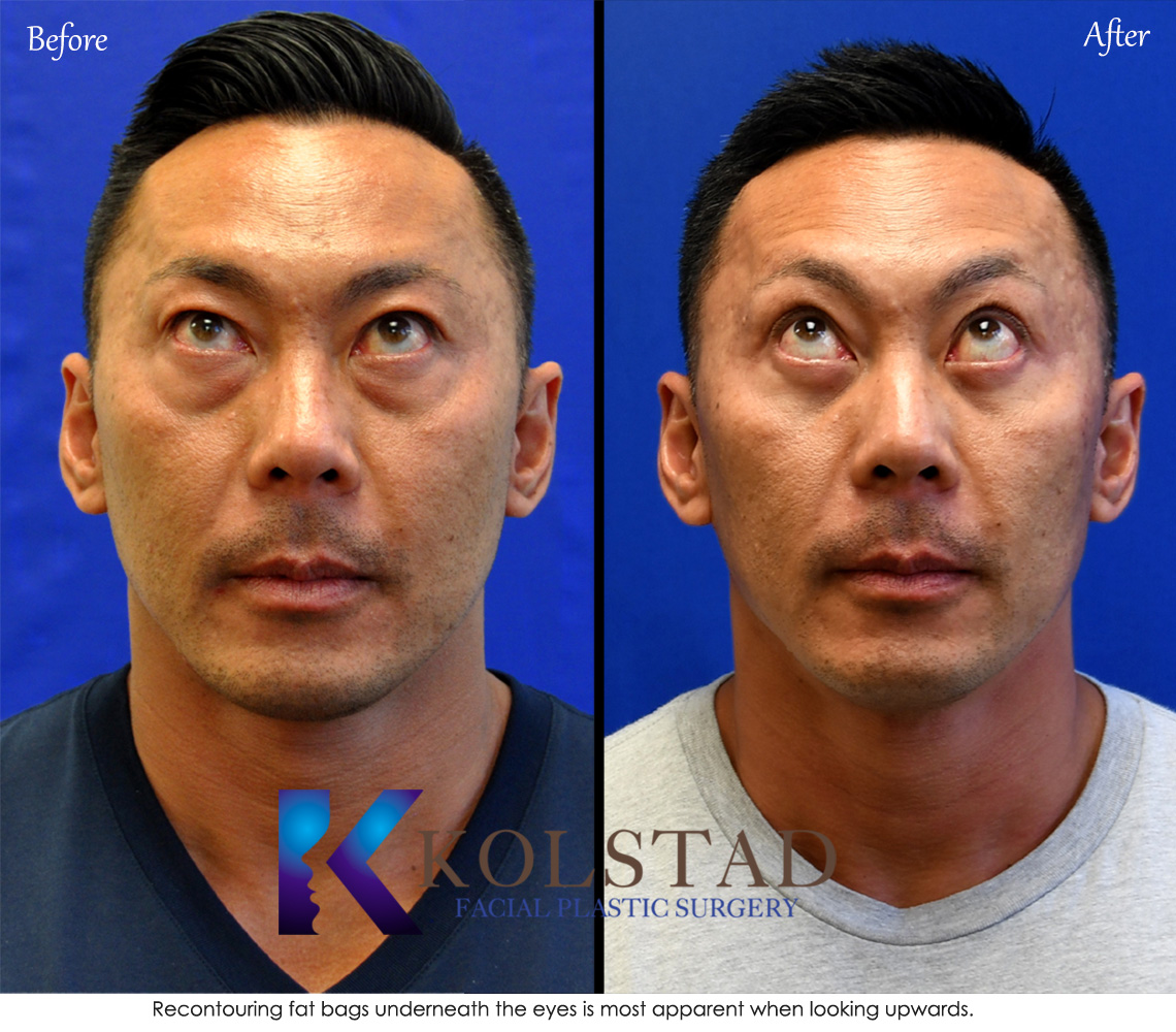 Before and after Asian lower eyelid surgery showing reduced under eye bags and smoother contour