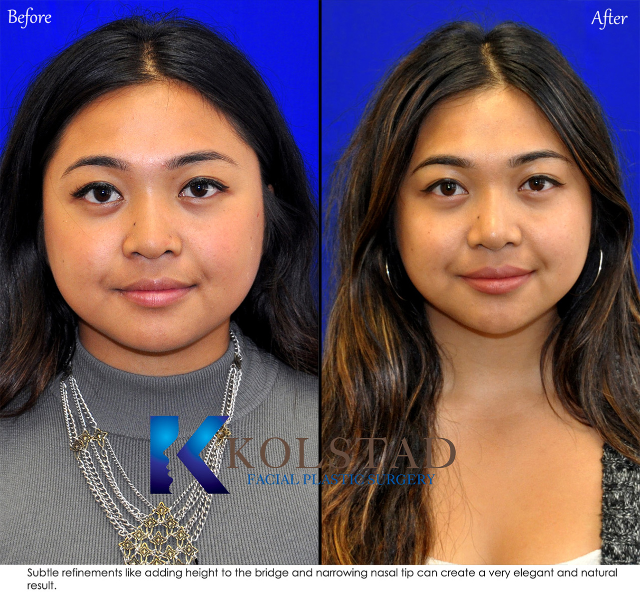 Asian rhinoplasty before and after profile view showing refined nasal contours and natural facial balance in San Diego, California