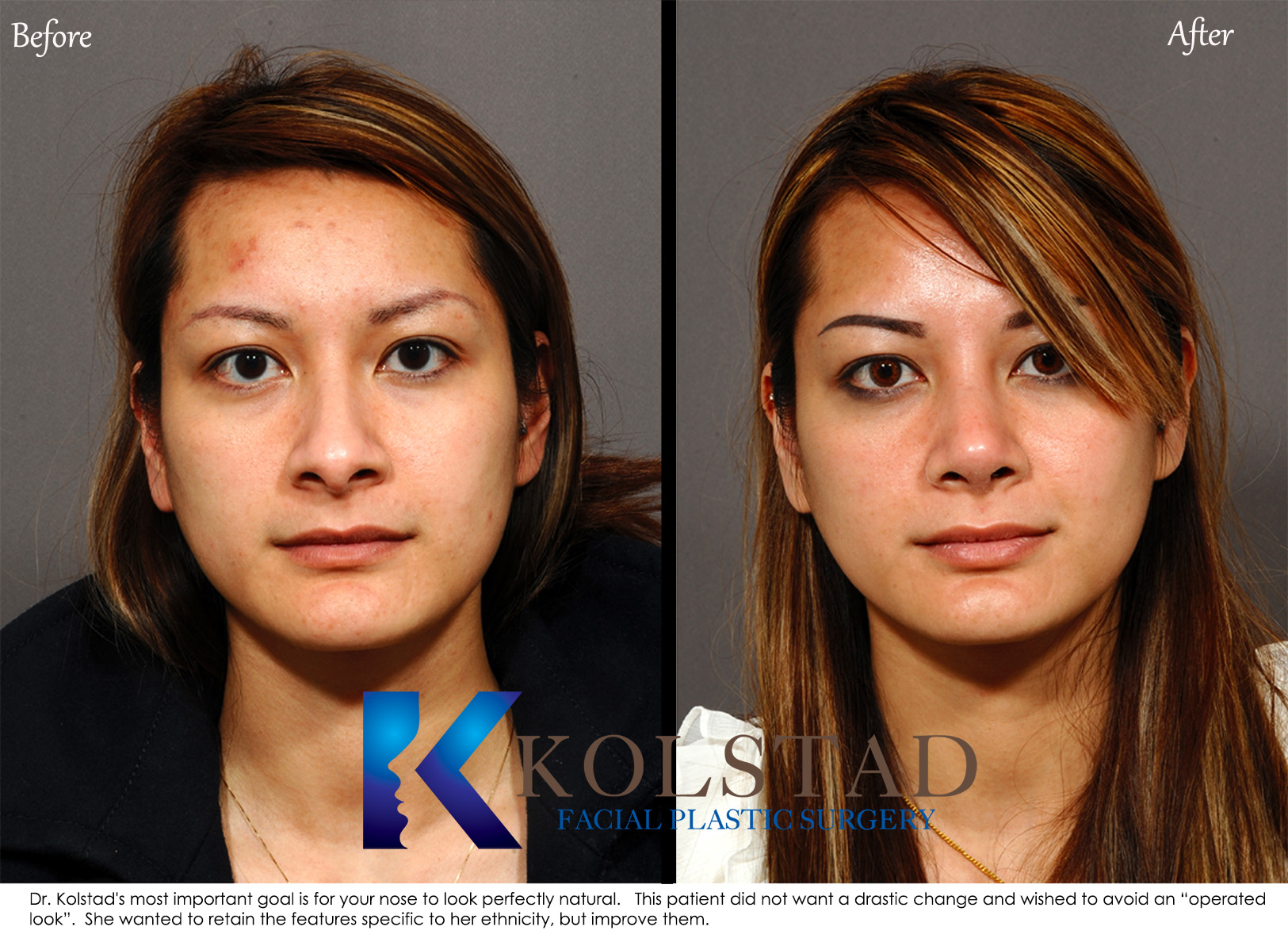 Asian rhinoplasty before and after front view showing a refined nose and balanced facial proportions in San Diego, California