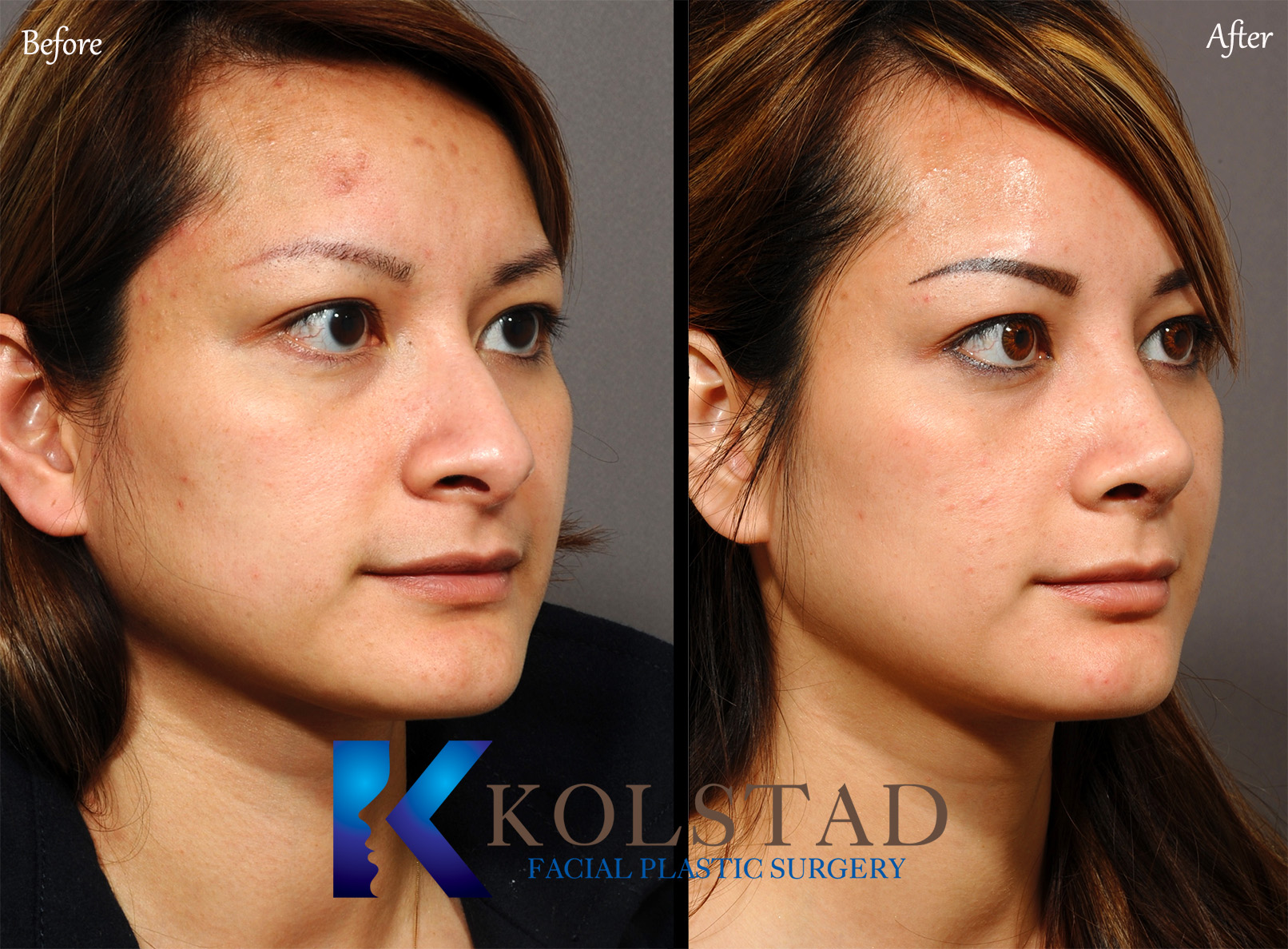 Asian rhinoplasty before and after showing a naturally refined nose with balanced facial proportions in San Diego, California