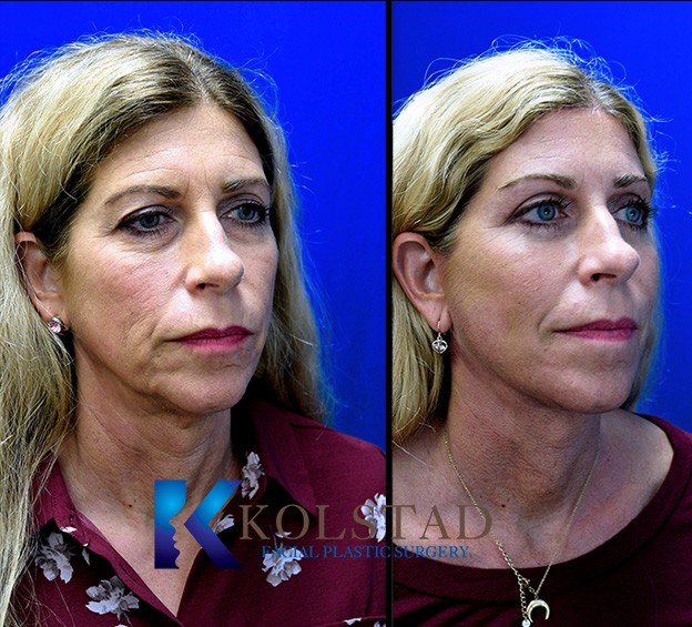 Before and after brow lift in San Diego showing lifted eyebrows, reduced forehead lines, and a more open eye appearance