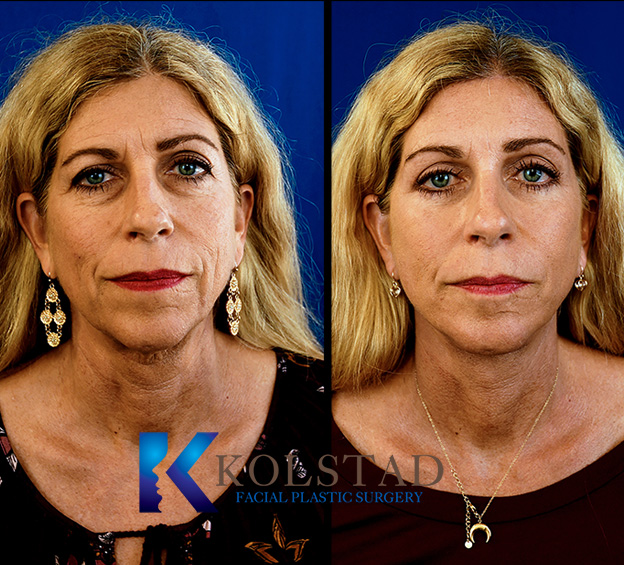 Before and after brow lift in California showing elevated brows, smoother forehead lines, and a more open eye appearance