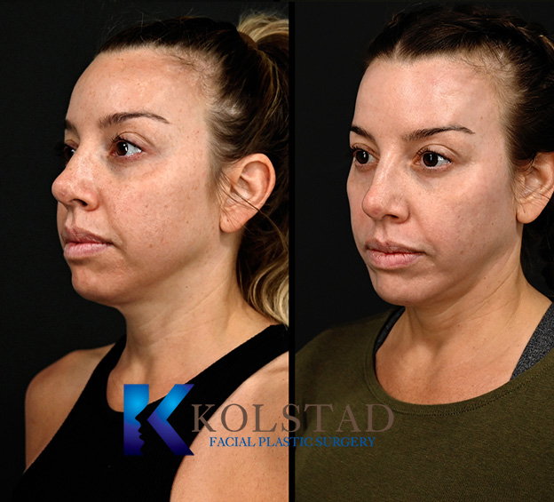 Before and after CO2 laser around the eyes in San Diego showing smoother skin and reduced fine lines and wrinkles