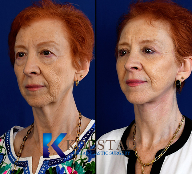 Before and after deep plane facelift in San Diego showing improved cheek support, reduced jowls, and smoother neck definition