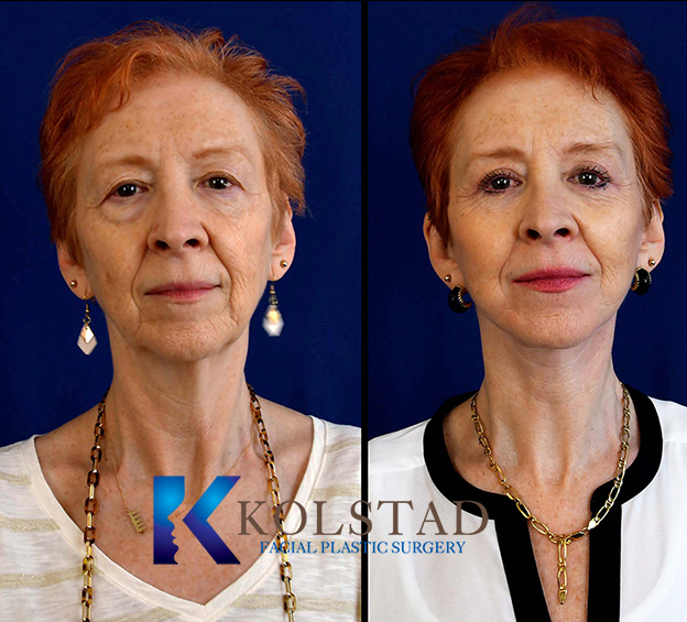 Before and after deep plane facelift in La Jolla showing lifted cheeks, improved jawline contour, and tightened neck appearance