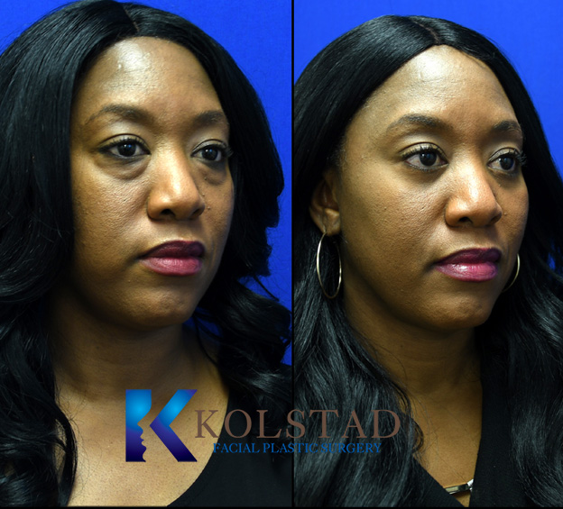 Before and after eye rejuvenation in La Jolla showing smoother upper eyelids and reduced under eye bags with a more refreshed appearance