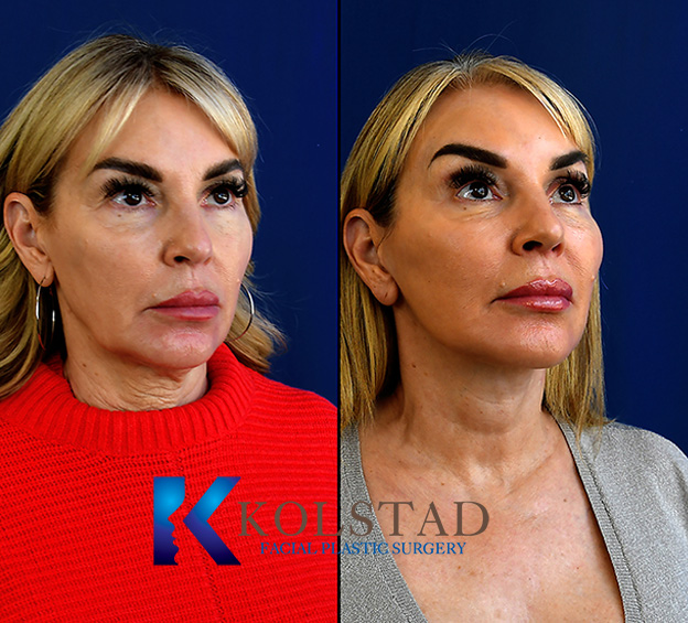 Before and after facelift in San Diego showing improved jawline definition, reduced facial sagging, and smoother neck contour