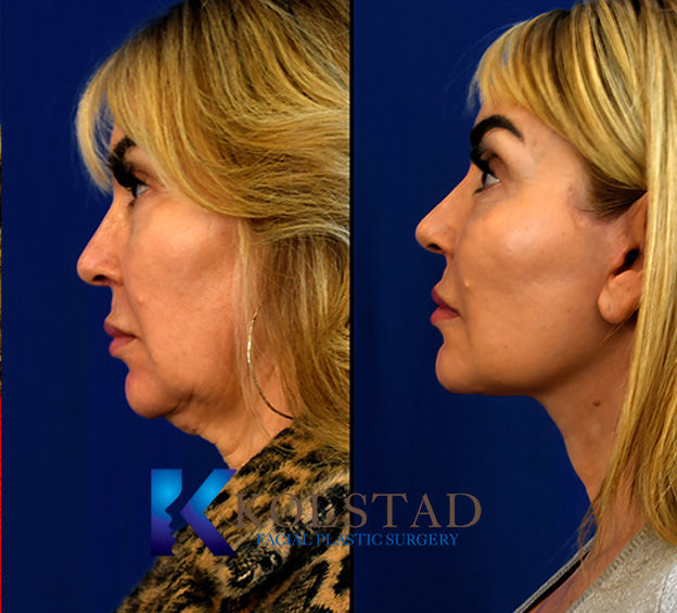 Before and after facelift in California showing elevated cheek position, smoother lower face, and improved neck definition