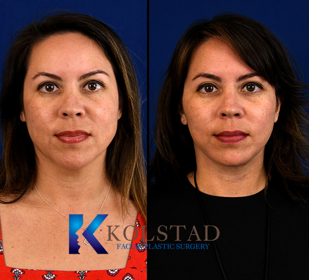 Before and after facelift in La Jolla for patients in their 40s showing improved jawline definition and correction of early facial sagging