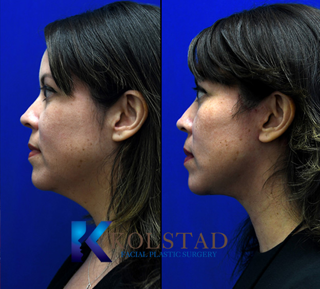 Before and after facelift in San Diego for patients in their 40s showing improved jawline definition and early sagging correction