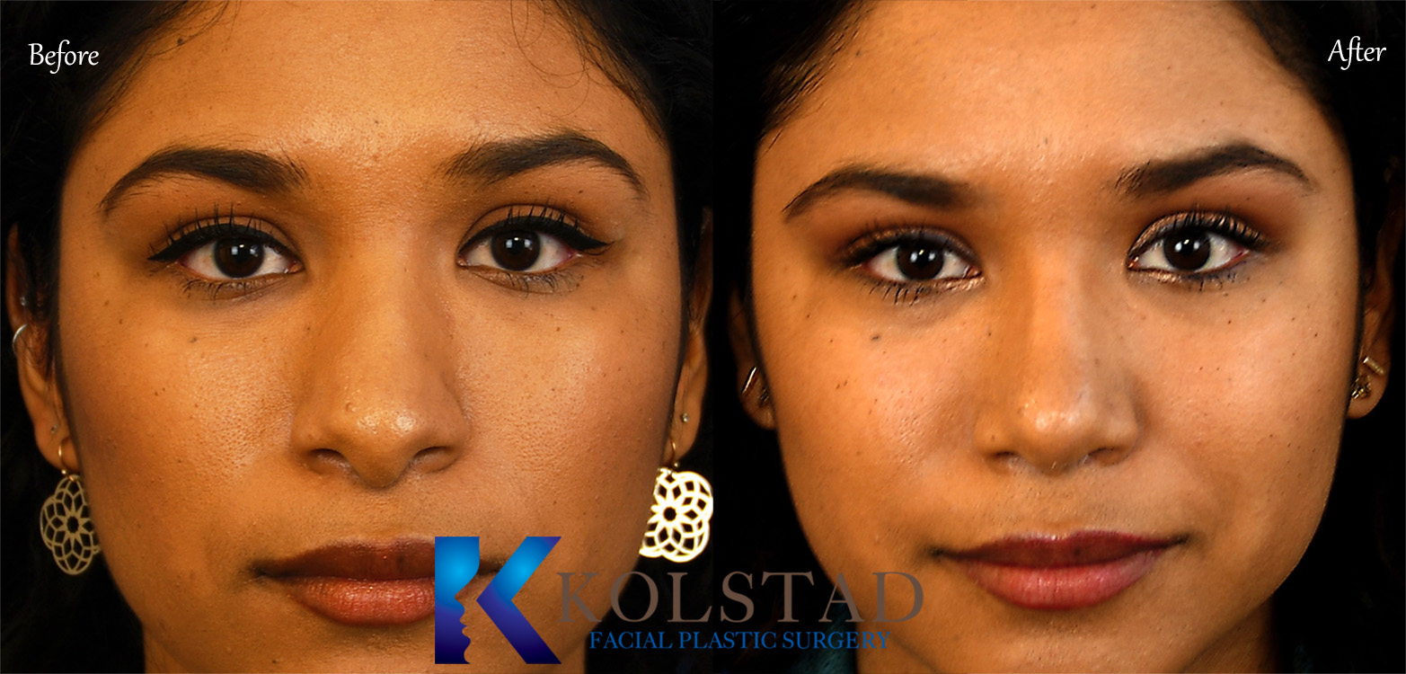 before and after rhinoplasty showing refined nasal contour with improved facial balance and natural proportions