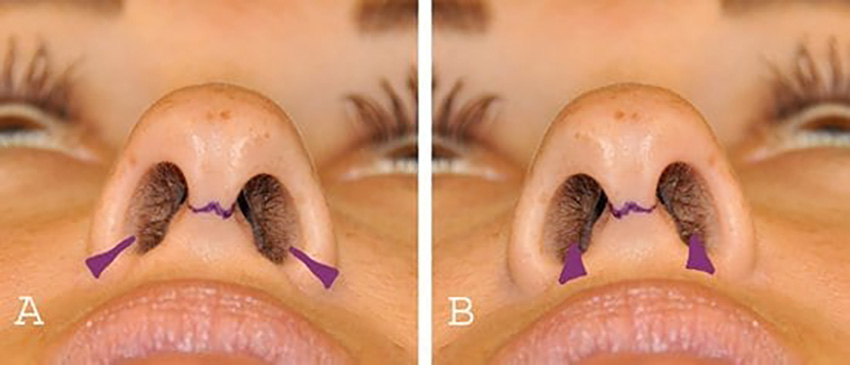 http://incisions-for-nostril-and-alar-base-reduction-3