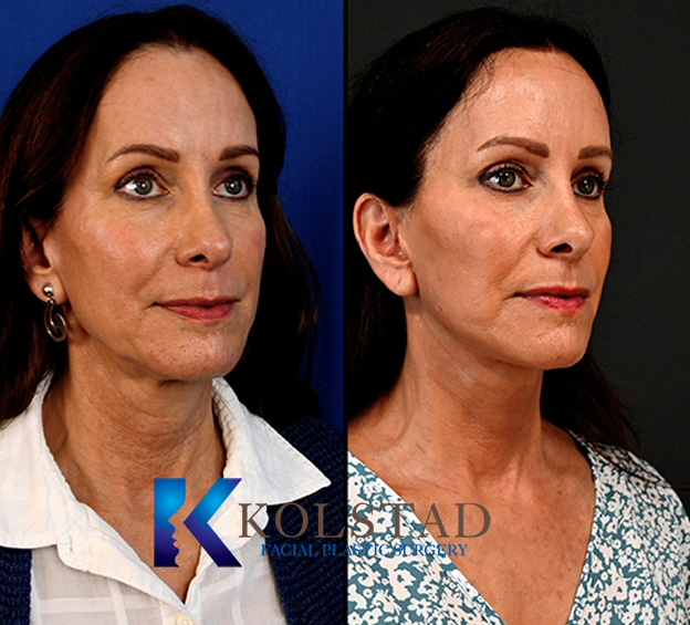 Before and after mini facelift in San Diego showing reduced jowls and improved lower face contour with a more youthful appearance