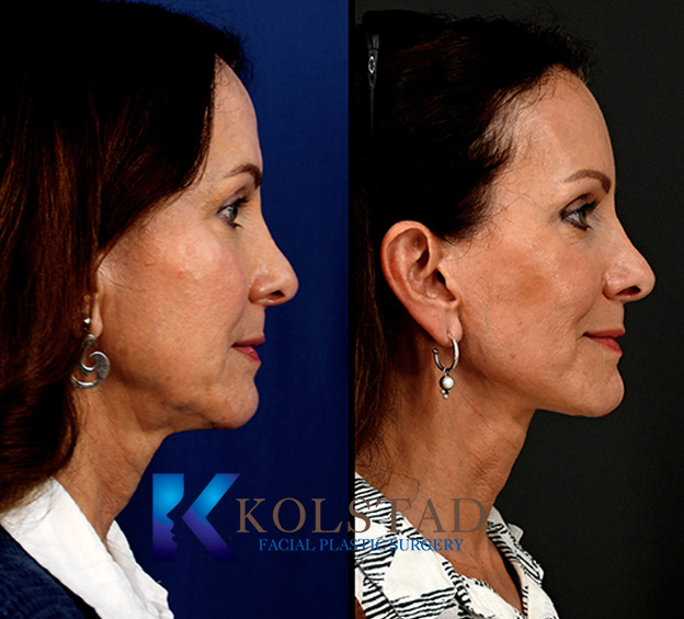 Before and after mini facelift in San Diego showing improved jawline definition and reduced early jowling for a refreshed lower face
