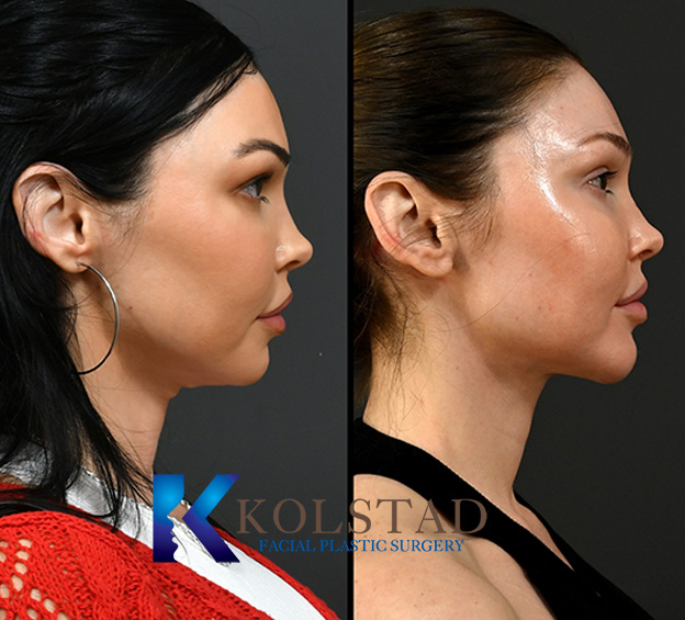 Before and after neck lift in San Diego showing reduced neck sagging and improved jawline definition for a more youthful appearance