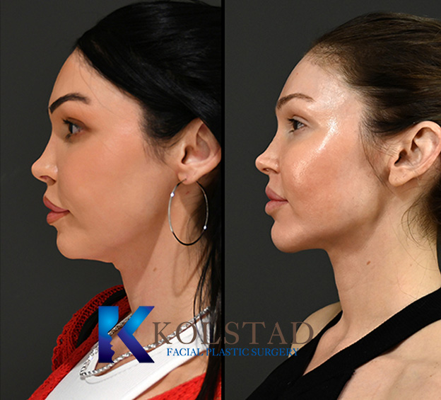 Before and after neck lift in La Jolla showing improved neck tightness, reduced sagging skin, and a more defined jawline