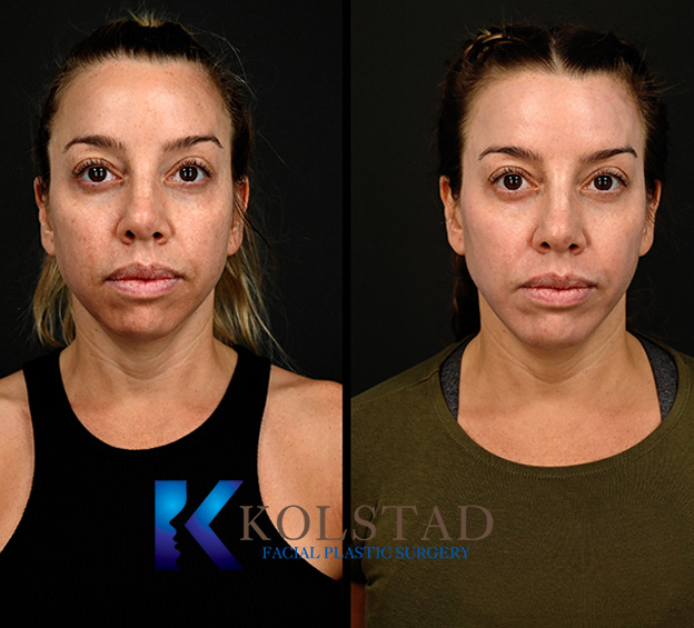 Before and after periorbital CO2 laser in San Diego showing smoother skin, reduced fine lines, and improved texture around the eyes
