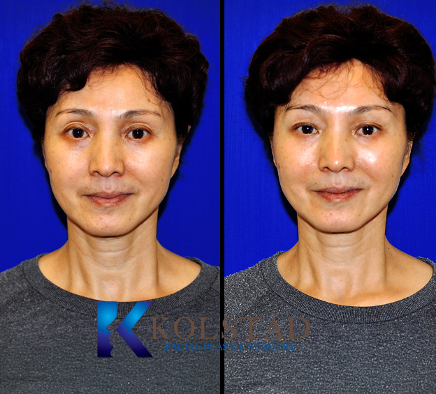 Before and after periorbital fat transfer in La Jolla showing improvement in under eye hollows and smoother, more youthful eye contours