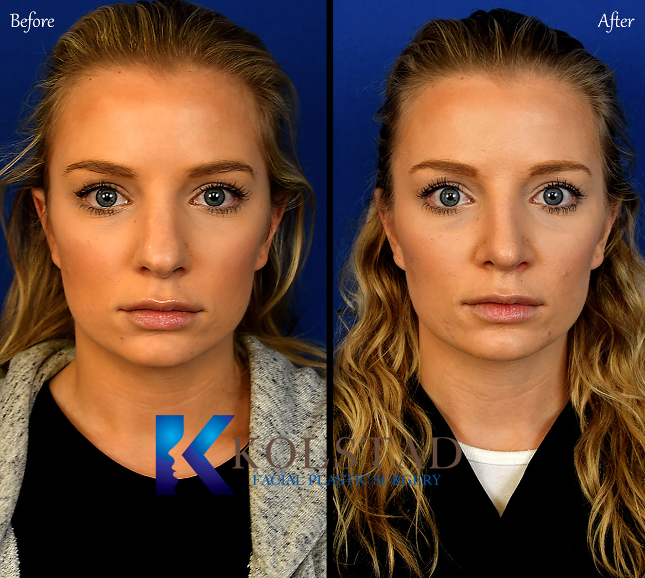 san diego nose job 400