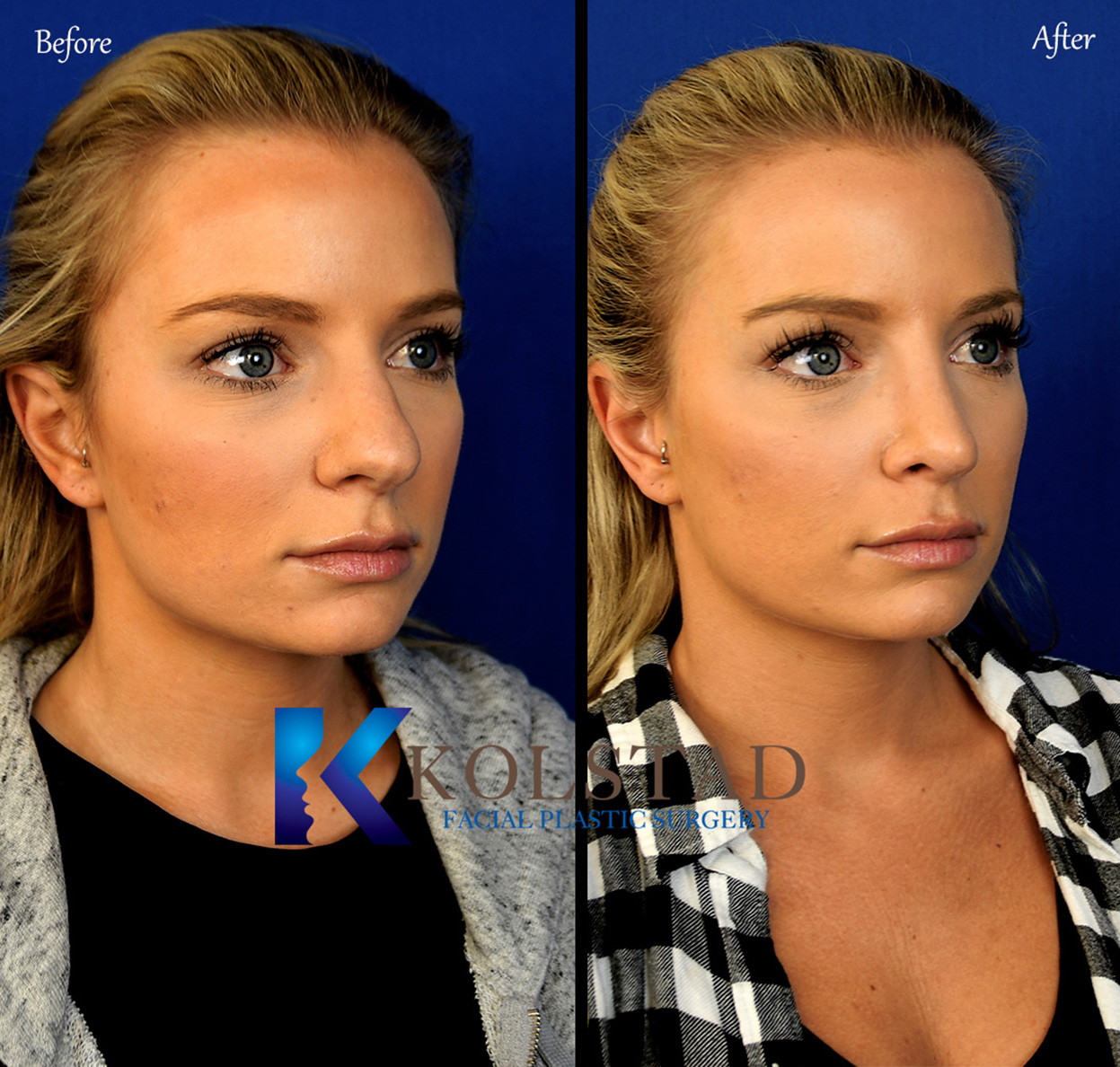 San Diego nose job before and after profile view showing refined nasal contours and improved facial balance