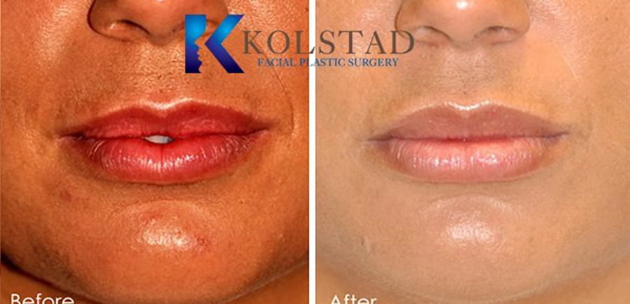 http://04-lip