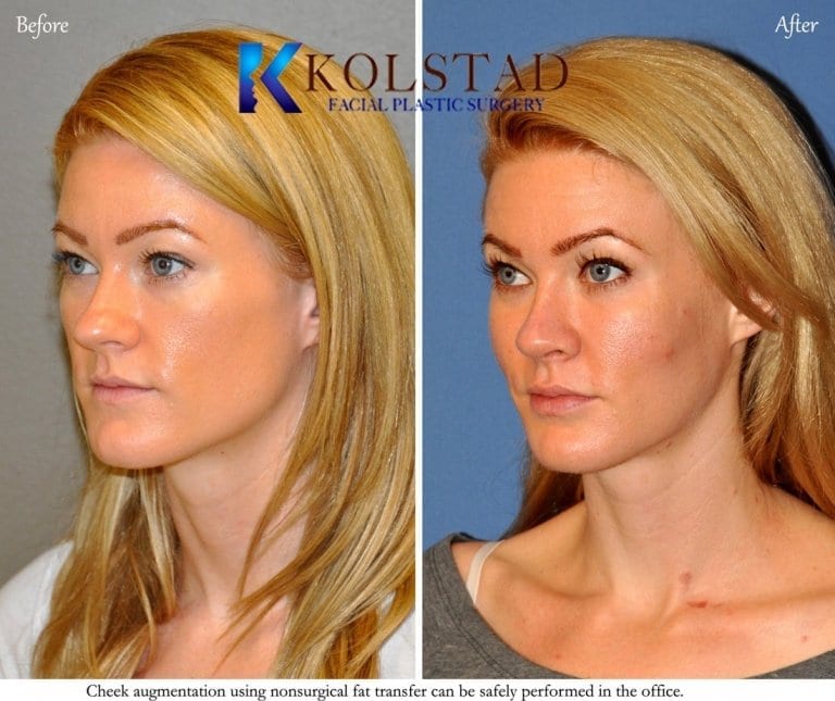 Facial fat transfer before and after showing restored volume and smoother facial contours in San Diego, California