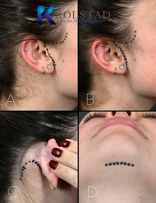 http://marking-for-face-lift-incisions-copy