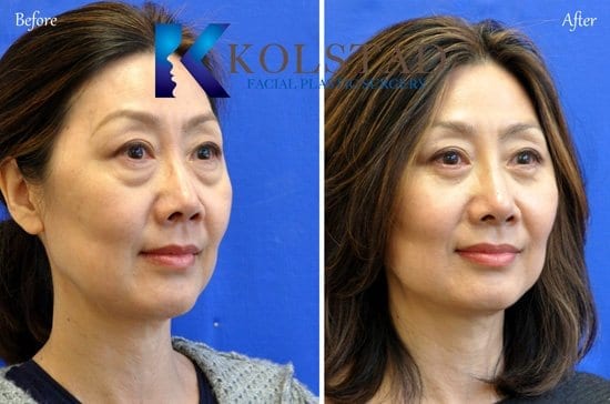 http://asian-nose-surgery-san-diego-501-copy-1