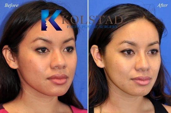 http://asian-nose-surgery-san-diego-502-copy-1