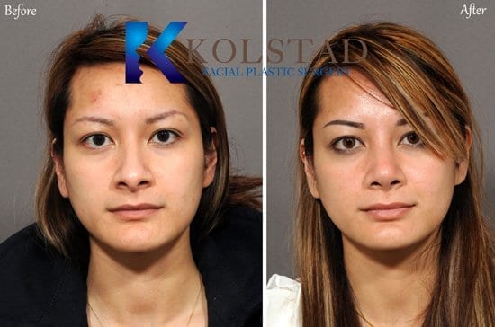 http://asian-nose-surgery-san-diego-503-copy