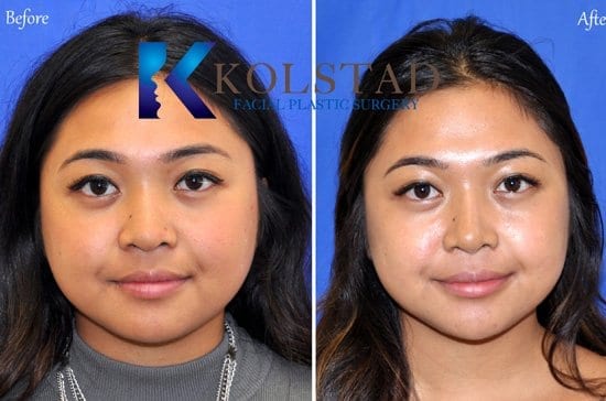 http://asian-nose-surgery-san-diego-504-copy