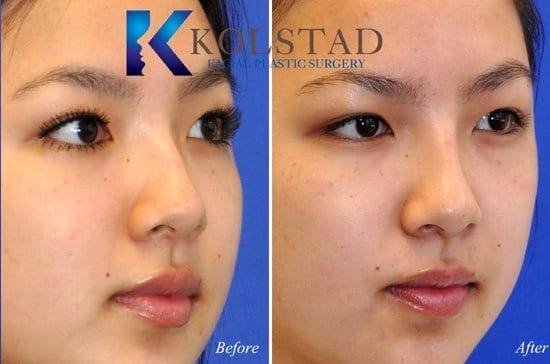 http://asian-nose-surgery-san-diego-506-copy