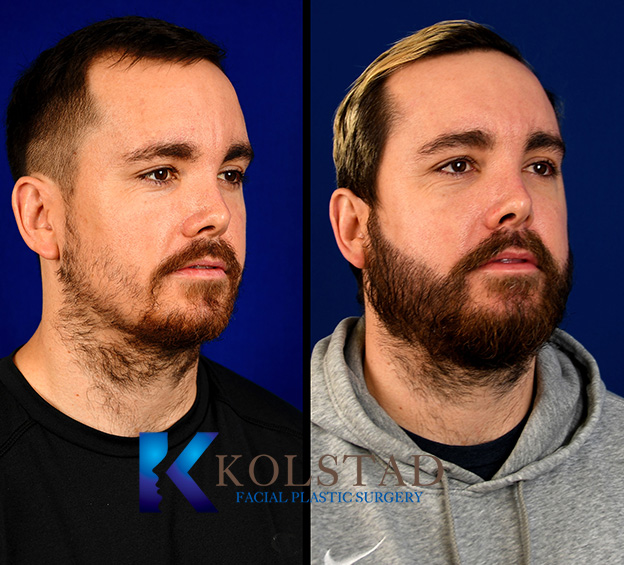 Before and after beard transplant showing improved facial hair density and a fuller, more defined beard appearance.