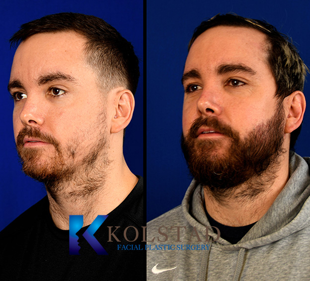 Before and after beard transplant showing improved facial hair density and a fuller, more defined beard appearance.