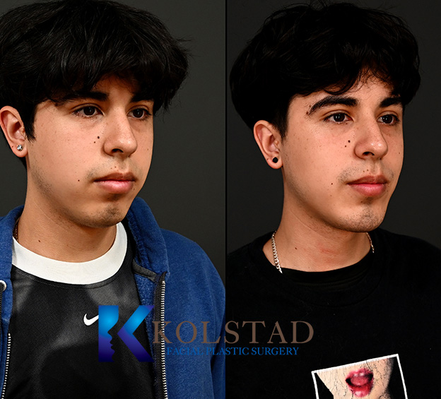 Before and after chin augmentation showing enhanced chin definition and improved balance between the chin and surrounding facial features.