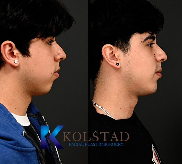 Before and after chin augmentation showing improved chin projection and more balanced facial proportions.