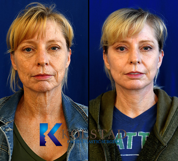 Before and after CO2 laser treatment showing improved skin texture and a smoother, more refreshed complexion in a front-facing view.