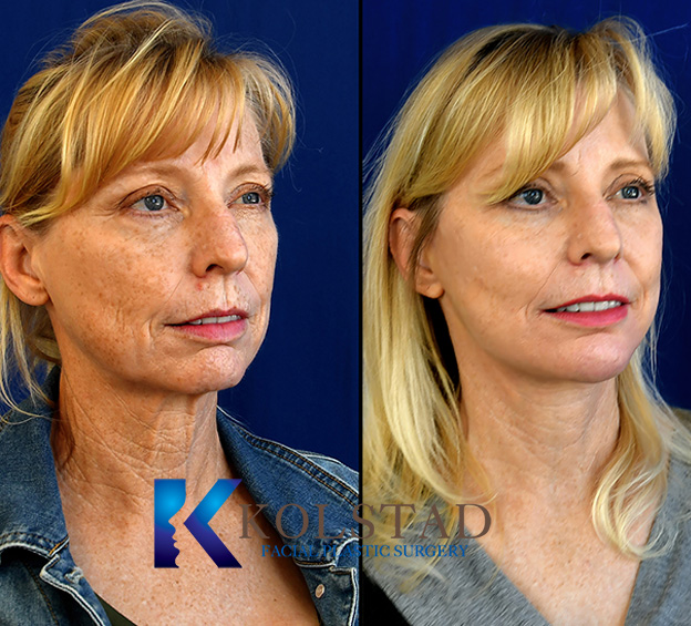 Before and after CO2 laser treatment showing smoother, more even-looking skin with improved texture and clarity.