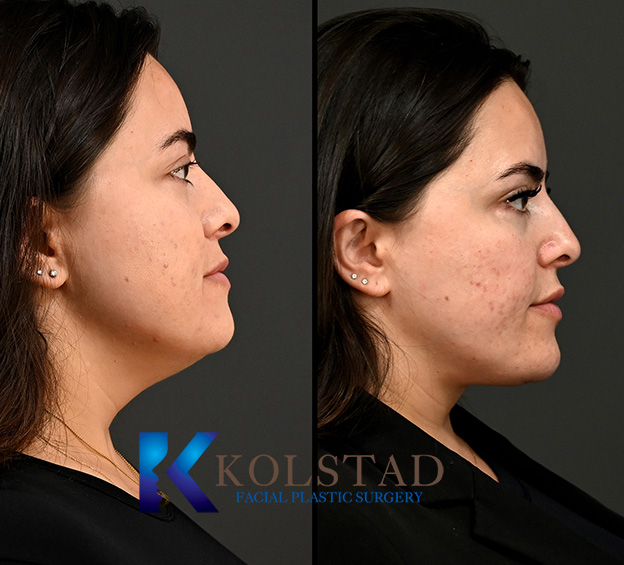 Before and after deep neck contouring showing improved neck definition and a more refined jawline from the side.