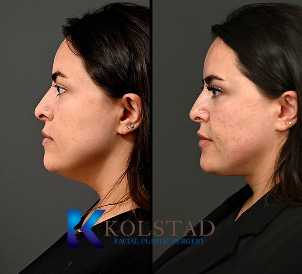 Before and after deep neck contouring showing a more defined neck and improved jawline contour.